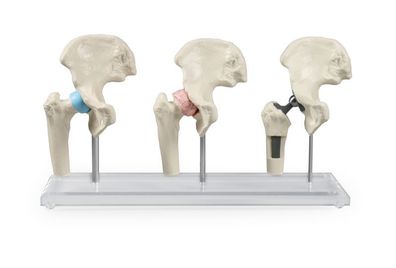 anatomisches Modell Hüfte, Implantat Oberschenkel, Hüftimplantat