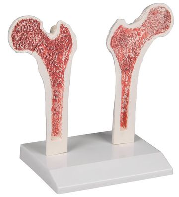 Osteoporose Oberschenkel Modell