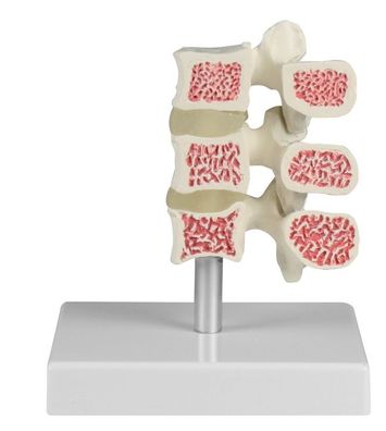 Osteoporose Wirbel Model, 3 Wirbel, median geschnitten einzeln vom Stativ abnehmbar