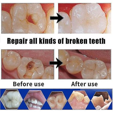 Reparatur von Zement-Zahnlücken, künstlichen Zähnen, festem Kleber, gesetztem Zahn