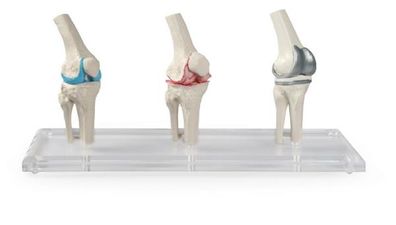 anatomisches Modell, Knie Implantat, 3 Modelle, 3 Stadien