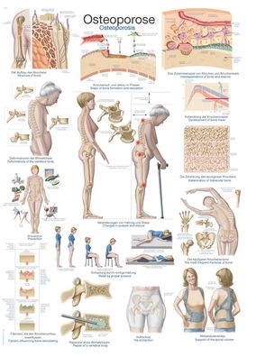 Lehrtafel Osteoporose 50x70cm