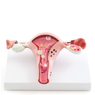 Gebärmuttermodell mit Erkrankungen Uterus-Modell HeineScientific