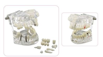 Demonstrationsmodell für Zahnerkrankungen & Lösungen