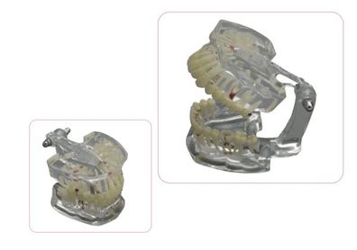 Demonstrationsmodell Erwachsener mit Zahnkrankheiten