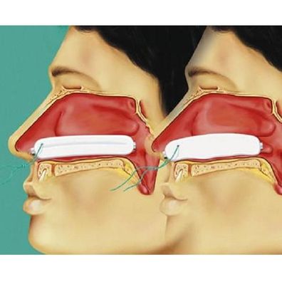 Raucocel Nasentamponade gerade m. Faden 45 mm 10 Stück