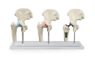 anatomisches Modell Hüfte 3 Stadien: gesund, erkrankt, mit Implantat, mit Stativ