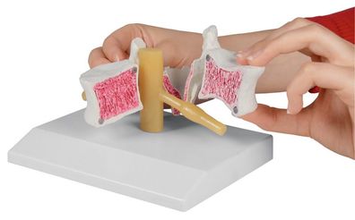 Osteoporose Wirbel 2-fach vergrößert, mit Stativ