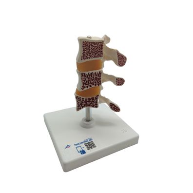 3B Scientific A78 Osteoporose Anatomie-Modell 3 Wirbel
