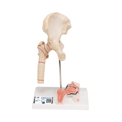 3B Scientific Hüftgelenk Anatomie mit Oberschenkelhalsfraktur und Arthrose PVC