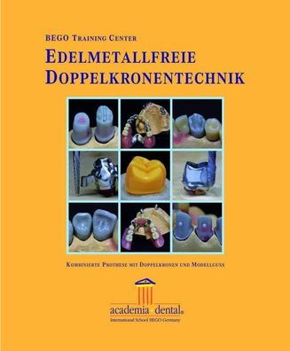 Edelmetallfreie Doppelkronentechnik: Kombinierte Prothese mit Doppelkronen und M